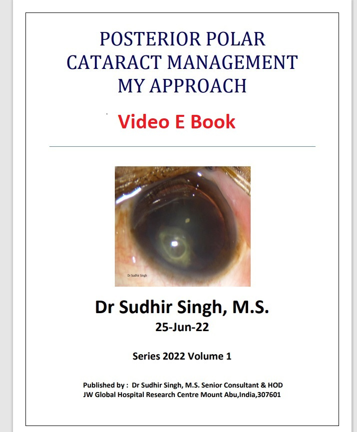 Posterior Polar Cataract Management Dr Sudhir Singh